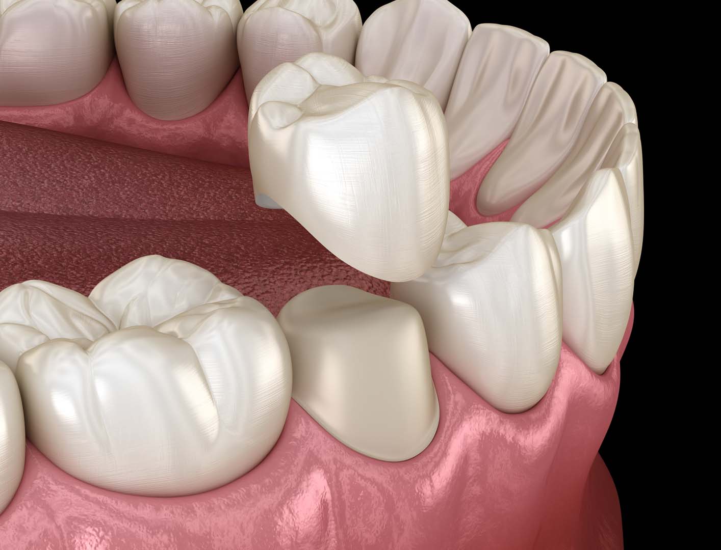 What Is a Dental Crown?