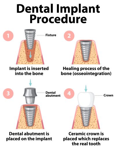 What Is a Dental Implant?