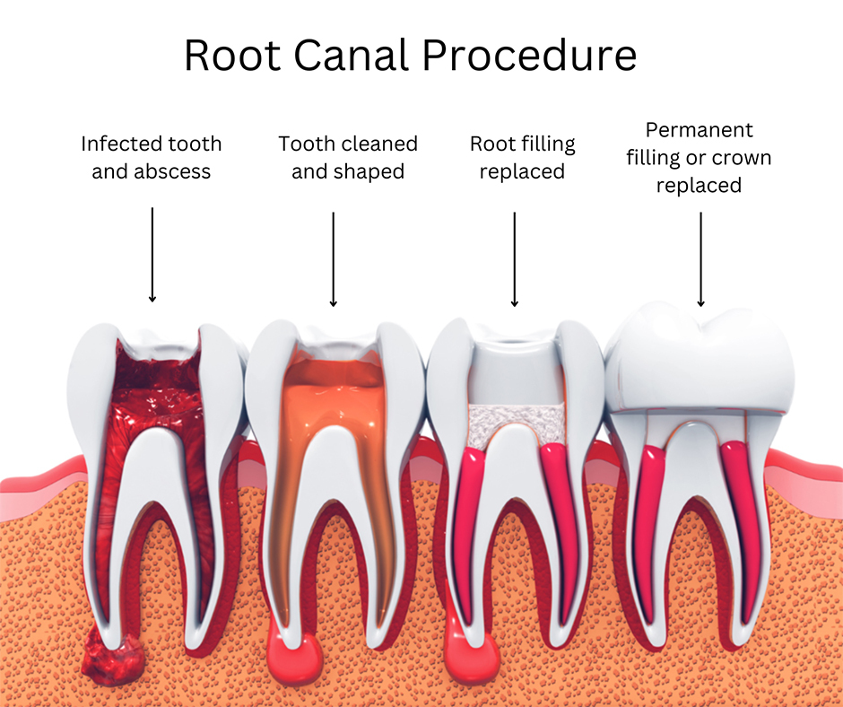 What Is a Root Canal?